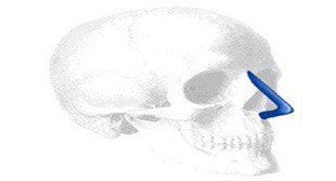 Voloshin Dorsal Columella Nasal Implantat 002