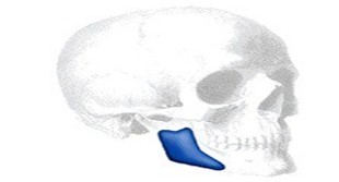 Taylor Lateral Mandibular Angle Implantat 4R/10, rechts