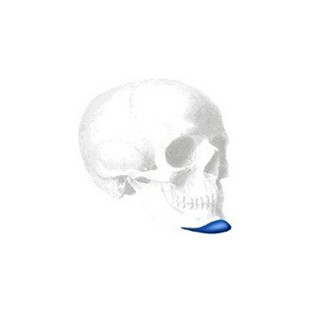 Extended Anatomical Kinn Implantat, X-Large