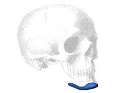 Terino Square Kinn Implantat Style II, Small