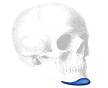 Mandibular Pre Jowl Kinn Implantat, Medium