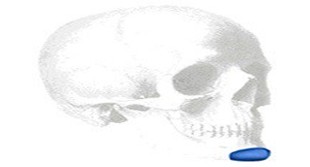 Curvilinear Silicone Kinn Implantat, X-Small