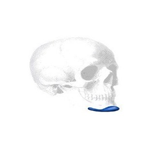 Terino Square Kinn Implantat Style I, Small