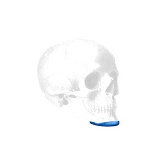 Manidublar Pre Jowl Implantat, Medium