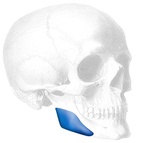 Vertical Mandibular Angle Implantat 7R, links