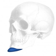 Anatomical Kinn Implant, Small