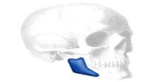 Taylor Posterior Mandibular Angle Implantat,rechts
