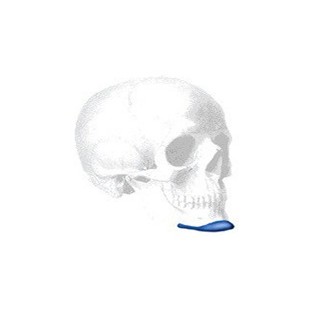 Terino Extended Anatomical Kinn Implantat, Small